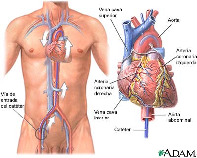 Cateterización cardíaca