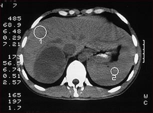 Tumor suprarrenal, tomografía computarizada