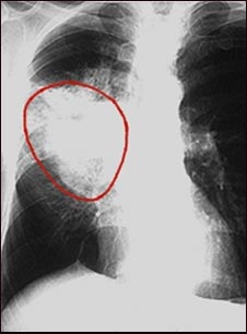 Cáncer de pulmón -Radiografía frontal del tórax