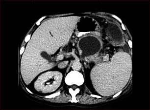Seudoquiste pancreático, Tomografía computarizada