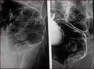 Rayos X de un cáncer rectal