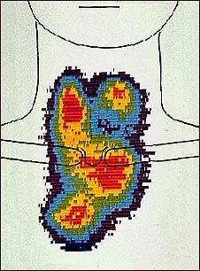 Gammagrafía del agrandamiento de la tiroides