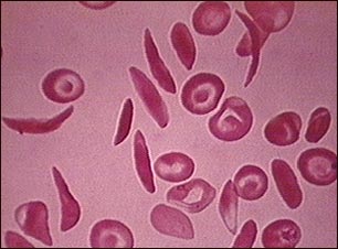 Glóbulos rojos drepanocíticos múltiples