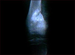 Rayos X de un sarcoma osteogénico