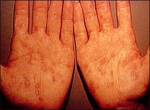 Sífilis secundaria en las palmas de las manos