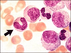 Vista microscópica: leucemia mielocítica crónica