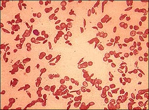 Glóbulos rojos drepanocíticos
