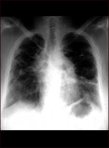 Sarcoide, etapa IV; rayos X de tórax