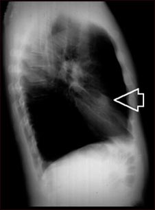 Nódulo pulmonar, lóbulo medio derecho- Radiografía de tórax
