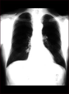 Nódulo pulmonar - Vista frontal de la radiografía de tórax