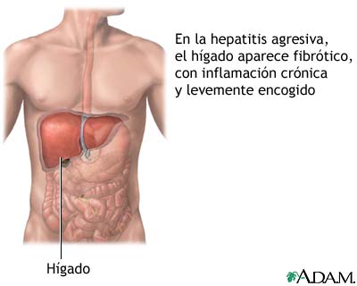 Hepatitis agresiva