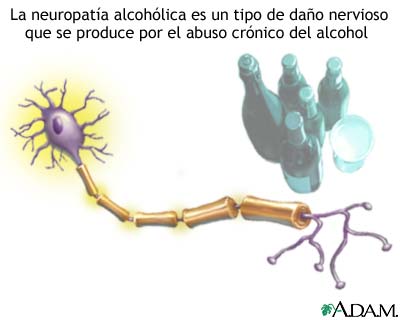 Neuropatía alcohólica
