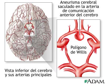 Aneurisma cerebral