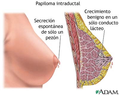 Papiloma intraductal