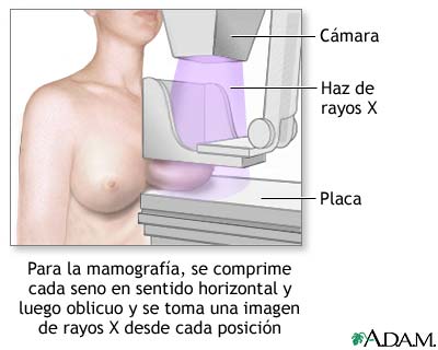 Mamograma