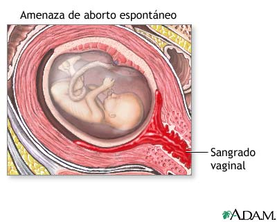 Aborto espontáneo