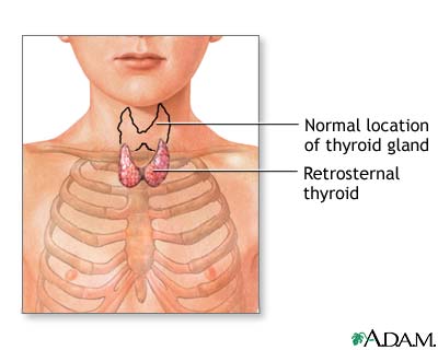 Tiroides retroesternal