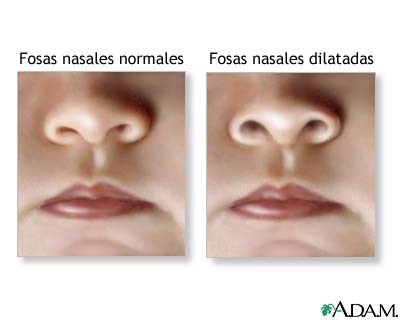 Dilatación de las fosas nasales