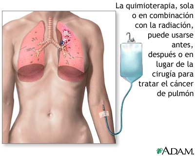 Tratamiento con quimioterapia para cáncer pulmonar