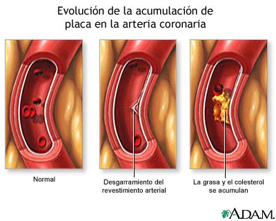 Acumulación progresiva de placa en arteria coronaria