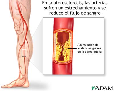 Arteriosclerosis de las extremidades