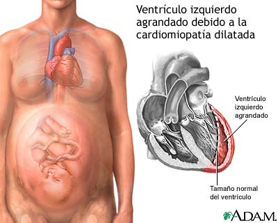 Cardiomiopatía periparto