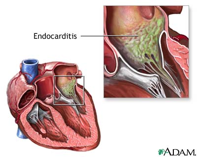 Endocarditis de cultivo negativo