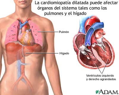 Cardiomiopatía dilatada