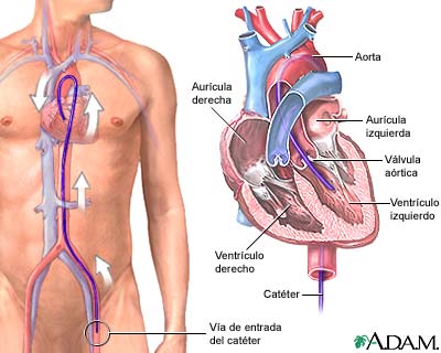 Cateterización del corazón izquierdo