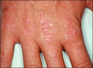 Dermatomiositis, pápulas de Gottron en las manos
