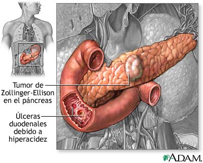 Causas de las úlceras pépticas