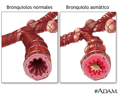 Bronquiolo normal vs. bronquiolo asmático