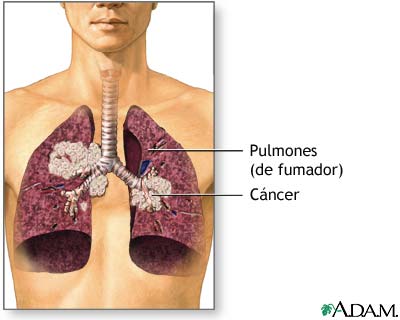 Humo de segunda mano y cáncer de pulmón