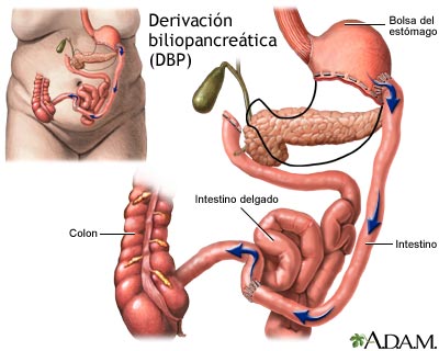 Derivación biliopancreática (BPD)