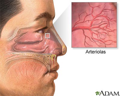 Hemorragia nasal