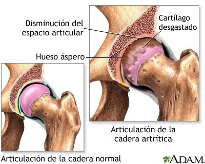Artritis en la cadera