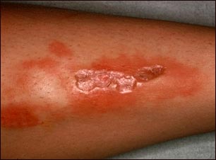 Necrobiosis lipoídica diabética en la pierna