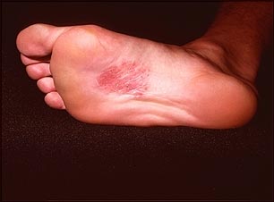 Dermatitis en la planta del pie por níquel