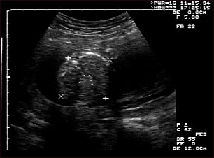 Ultrasonido de un feto normal; medidas del abdomen