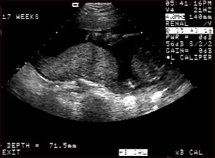 Ultrasonido de una placenta normal - Braxton Hicks
