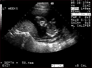 Ultrasonido de un feto normal; cara
