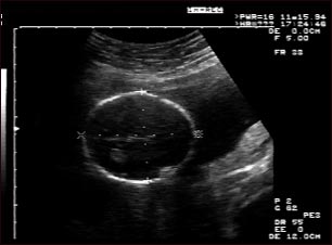Ultrasonido de un feto normal; medidas de la cabeza