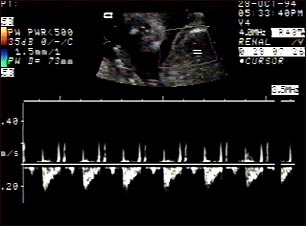 Ultrasonido normal de los latidos del feto