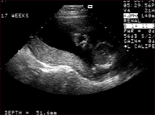 Ultrasonido normal , placenta relajada