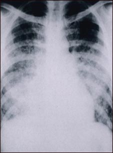 Pulmonía aguda por varicela - Rayos X de tórax
