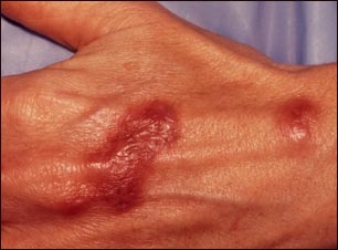 Infección por Mycobacterium marinum en la mano