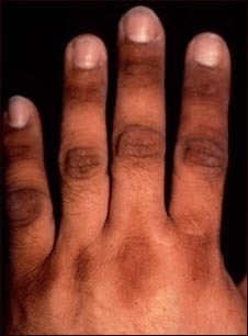 Acantosis nigricans de la mano