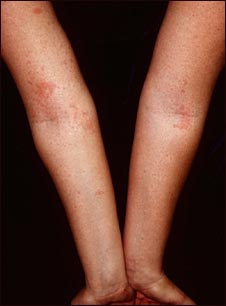 Dermatitis atópica de los brazos