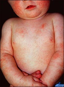 Dermatitis atópica en un bebé
