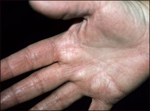 Hiperlinearidad de la dermatitis atópica de la palma de la mano